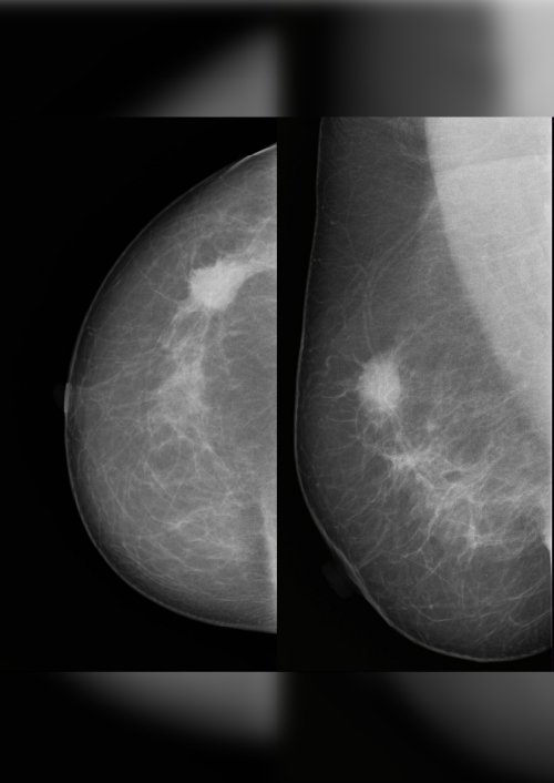 Caso Cáncer de Mama