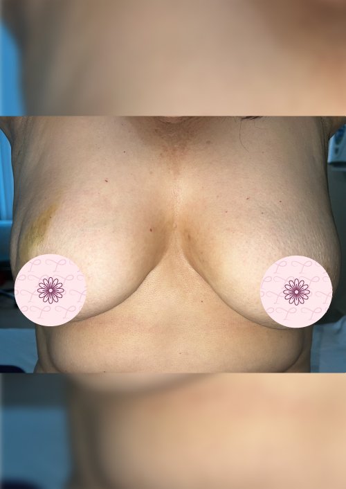 Caso Cáncer de Mama