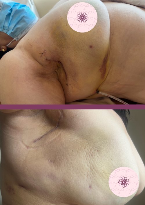 Caso Cáncer de Mama